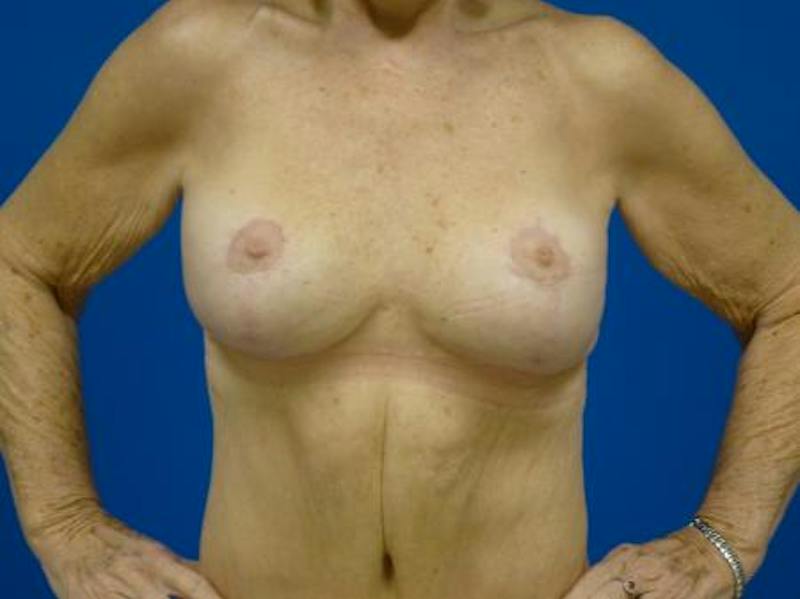 Breast Augmentation With Lift Before & After Gallery - Patient 102770 - Image 2