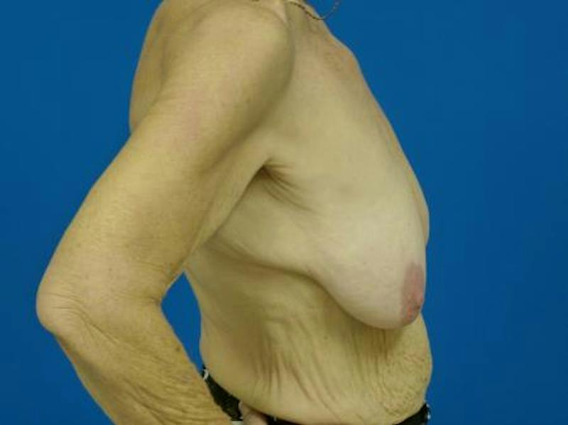 Breast Augmentation With Lift Before & After Gallery - Patient 102770 - Image 3