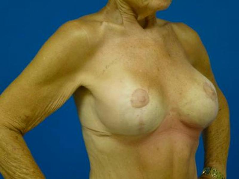 Breast Augmentation With Lift Before & After Gallery - Patient 102770 - Image 4