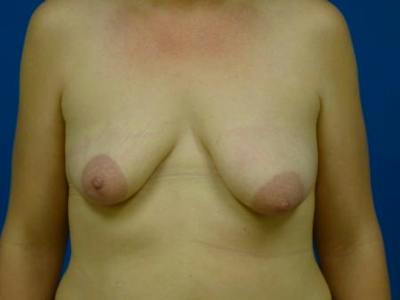 Breast Augmentation With Lift Before & After Gallery - Patient 294605 - Image 1