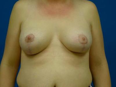 Breast Augmentation With Lift Before & After Gallery - Patient 294605 - Image 2