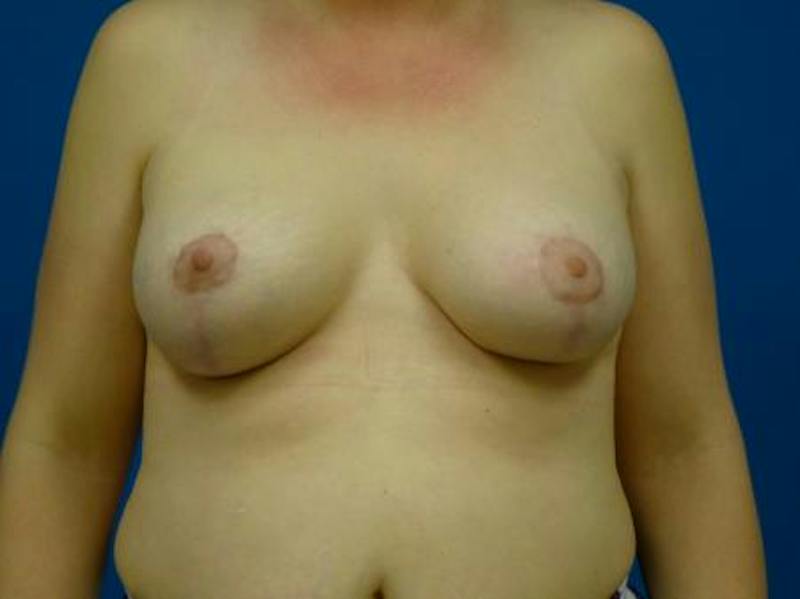 Breast Augmentation With Lift Before & After Gallery - Patient 294605 - Image 2