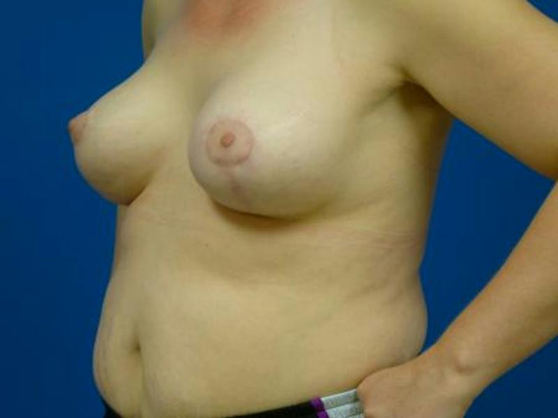 Breast Augmentation With Lift Before & After Gallery - Patient 294605 - Image 4