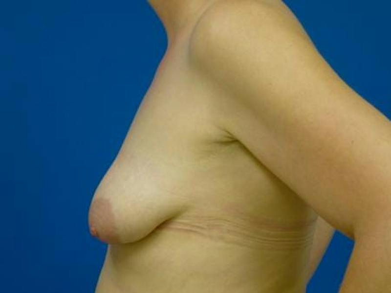 Breast Augmentation With Lift Before & After Gallery - Patient 294605 - Image 5