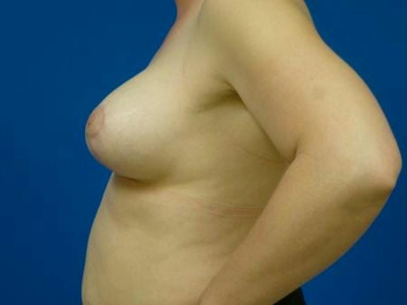 Breast Augmentation With Lift Before & After Gallery - Patient 294605 - Image 6