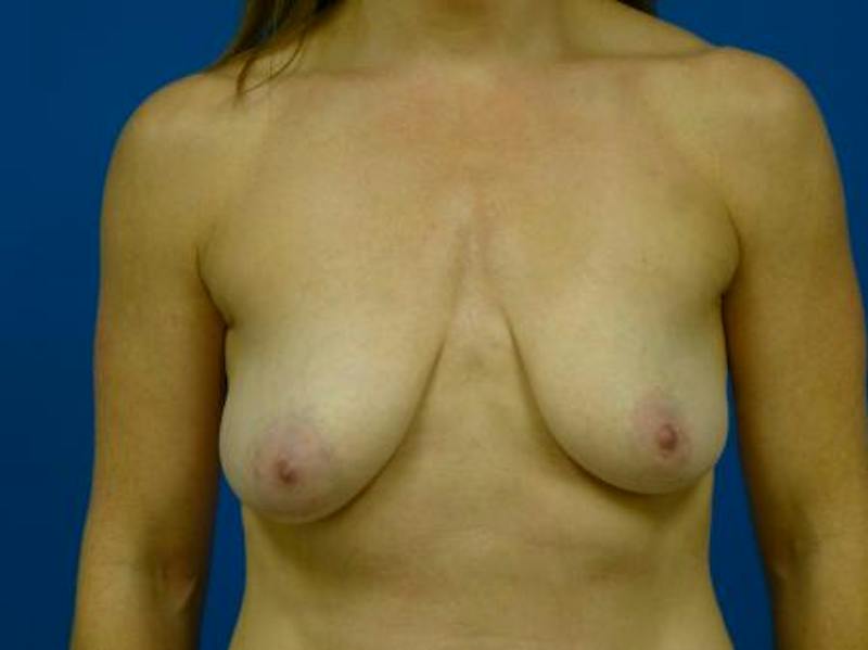 Breast Augmentation With Lift Before & After Gallery - Patient 543663 - Image 1