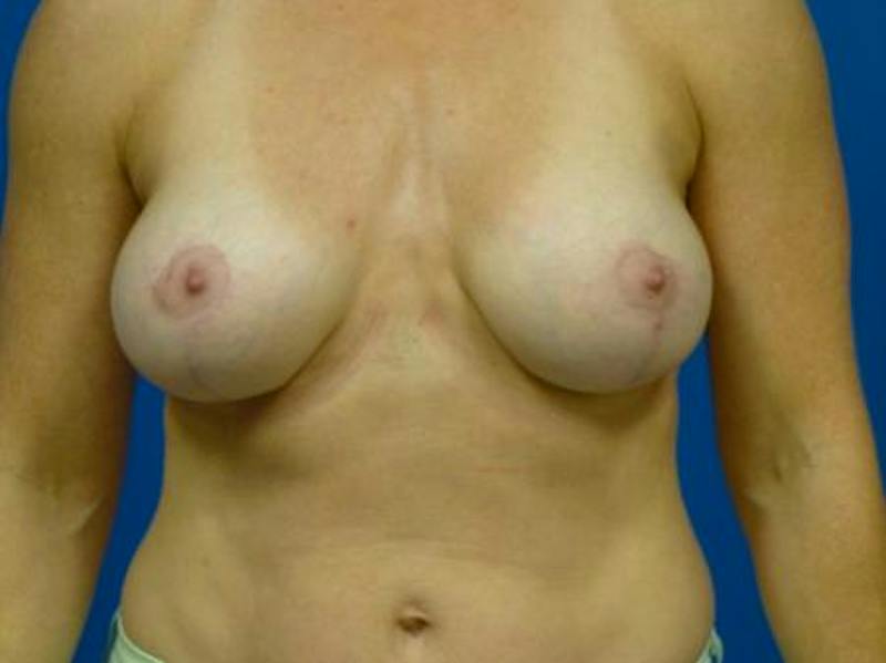 Breast Augmentation With Lift Before & After Gallery - Patient 543663 - Image 2