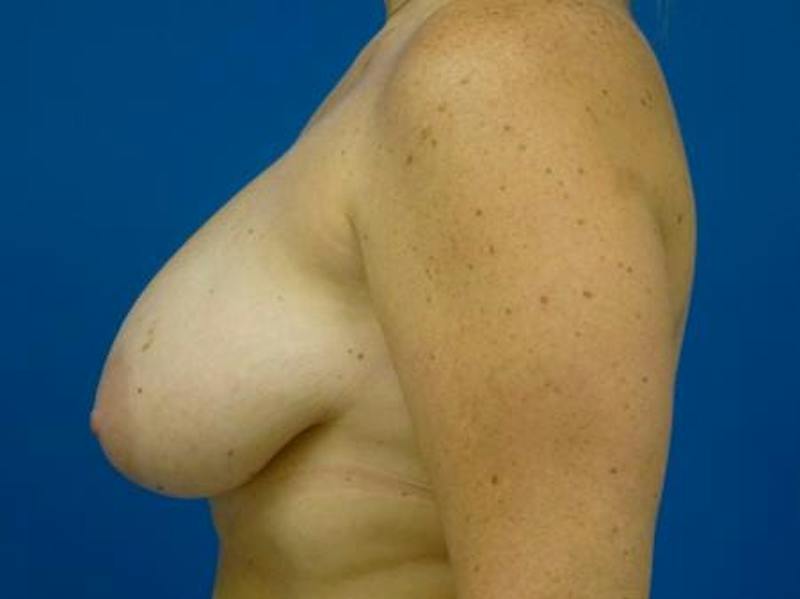 Breast Augmentation With Lift Before & After Gallery - Patient 163504 - Image 5