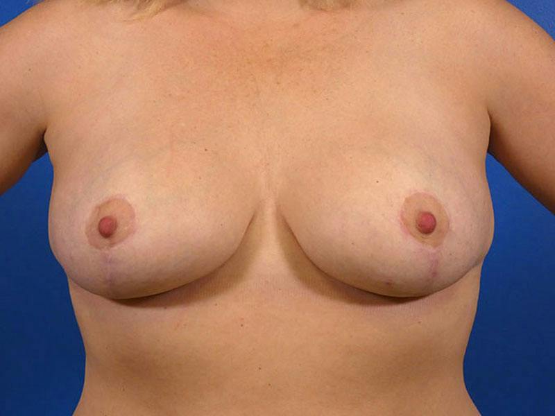 Breast Augmentation With Lift Before & After Gallery - Patient 385120 - Image 2