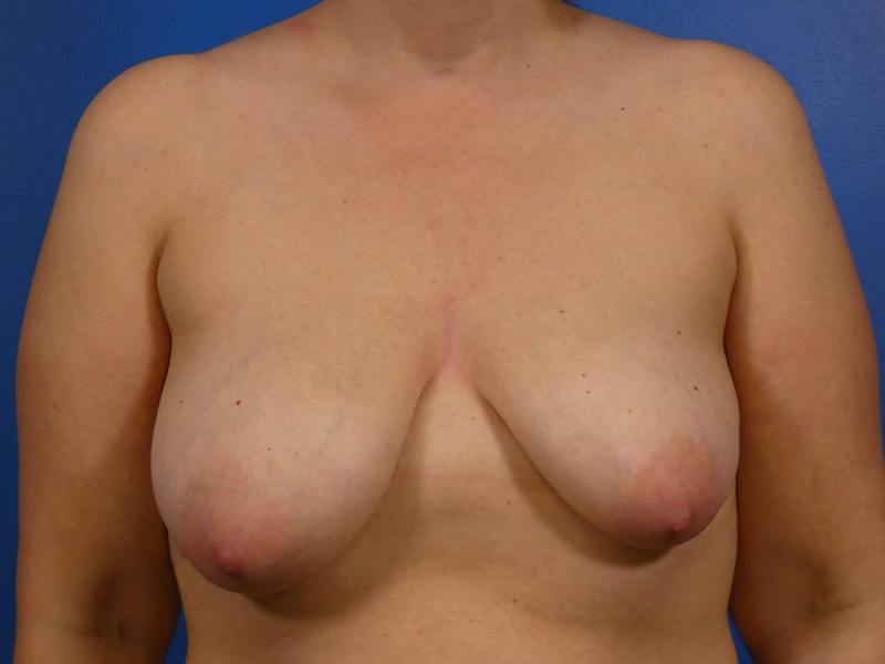 Breast Augmentation With Lift Before & After Gallery - Patient 128155 - Image 1