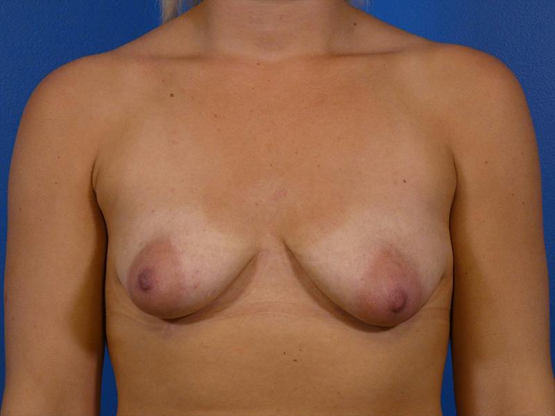 Breast Augmentation With Lift Before & After Gallery - Patient 355587 - Image 1
