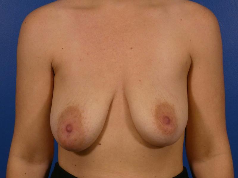 Breast Augmentation With Lift Before & After Gallery - Patient 161475 - Image 1