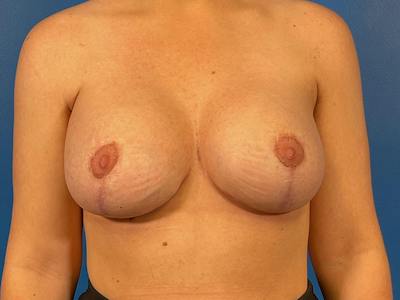 Breast Augmentation With Lift Before & After Gallery - Patient 161475 - Image 2