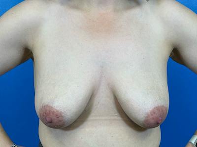 Breast Augmentation With Lift Before & After Gallery - Patient 136688 - Image 1