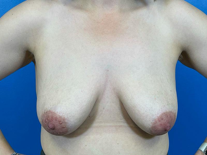Breast Augmentation With Lift Before & After Gallery - Patient 136688 - Image 1