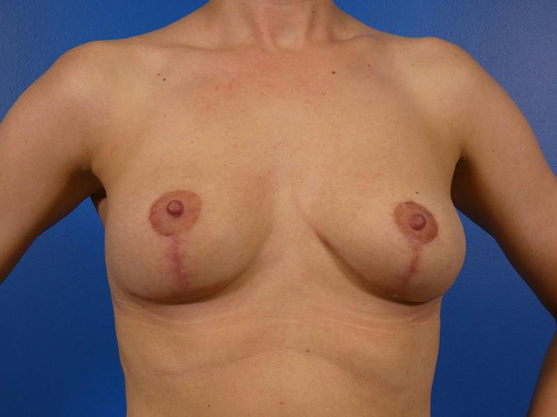 Breast Lift Before & After Gallery - Patient 276654 - Image 2