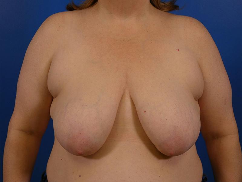 Breast Lift Before & After Gallery - Patient 125531 - Image 1