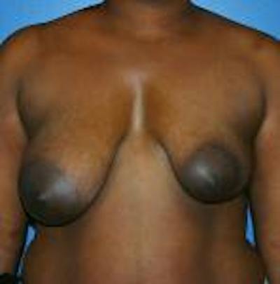 Breast Lift Before & After Gallery - Patient 171223 - Image 1