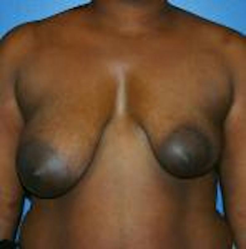 Breast Lift Before & After Gallery - Patient 171223 - Image 1