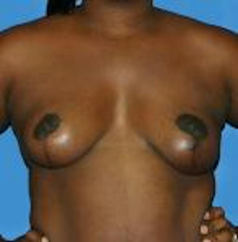 Breast Lift Before & After Gallery - Patient 171223 - Image 2