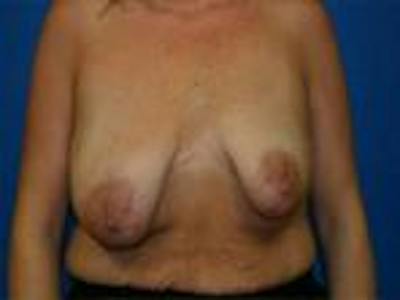 Breast Lift Before & After Gallery - Patient 153310 - Image 1