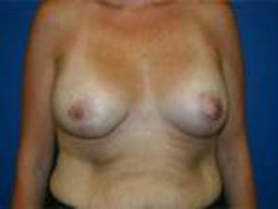 Breast Lift Before & After Gallery - Patient 153310 - Image 2