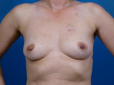 Breast Reconstruction Before & After Gallery - Patient 590014 - Image 1