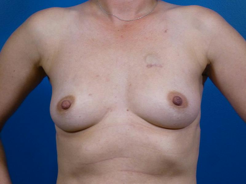 Breast Reconstruction Before & After Gallery - Patient 590014 - Image 1