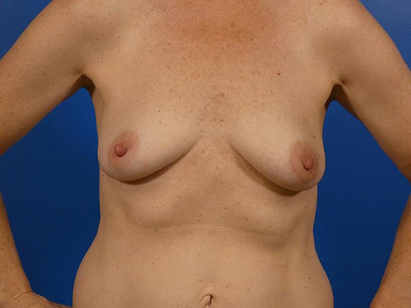 Breast Reconstruction Before & After Gallery - Patient 232680 - Image 1
