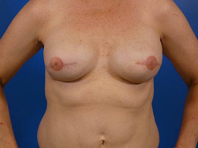 Breast Reconstruction Before & After Gallery - Patient 232680 - Image 2