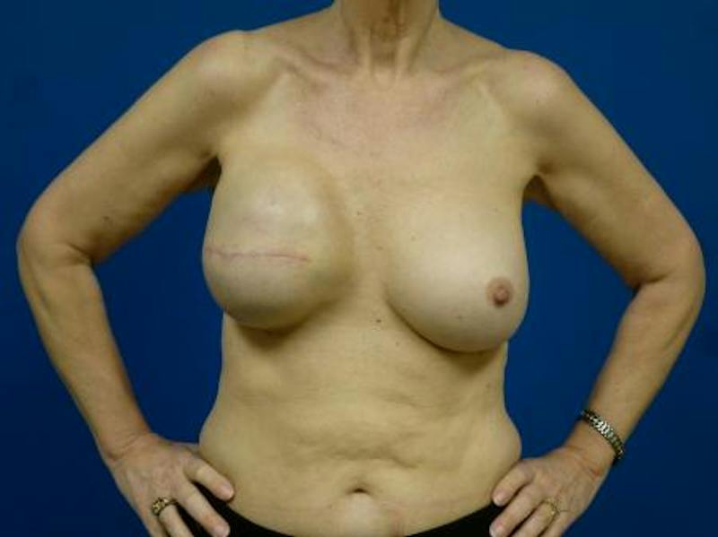 Breast Reconstruction Before & After Gallery - Patient 114510 - Image 1