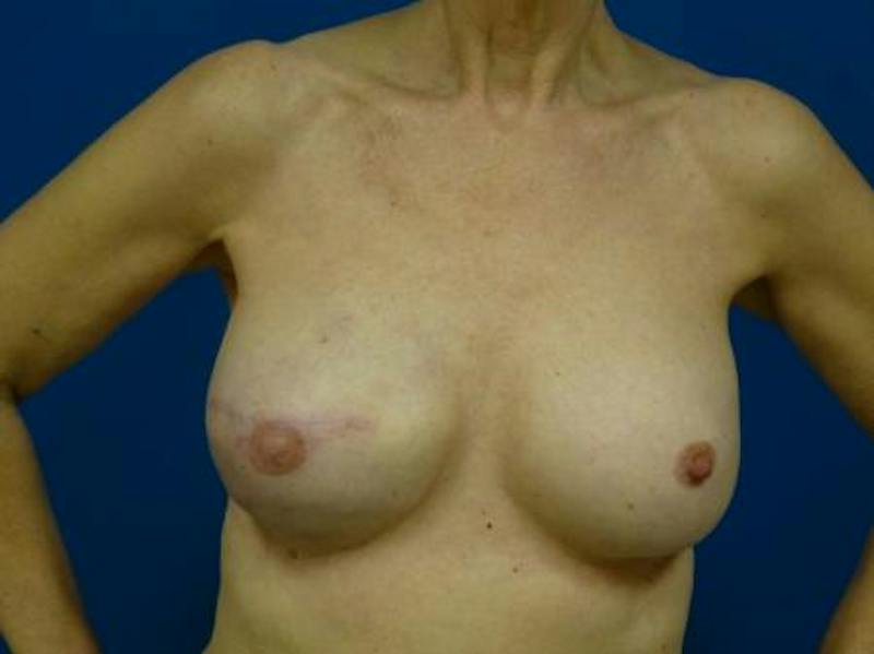 Breast Reconstruction Before & After Gallery - Patient 114510 - Image 2