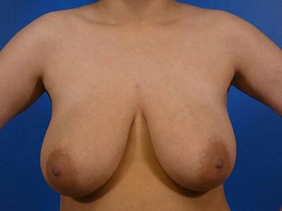 Breast Reduction Before & After Gallery - Patient 679513 - Image 1