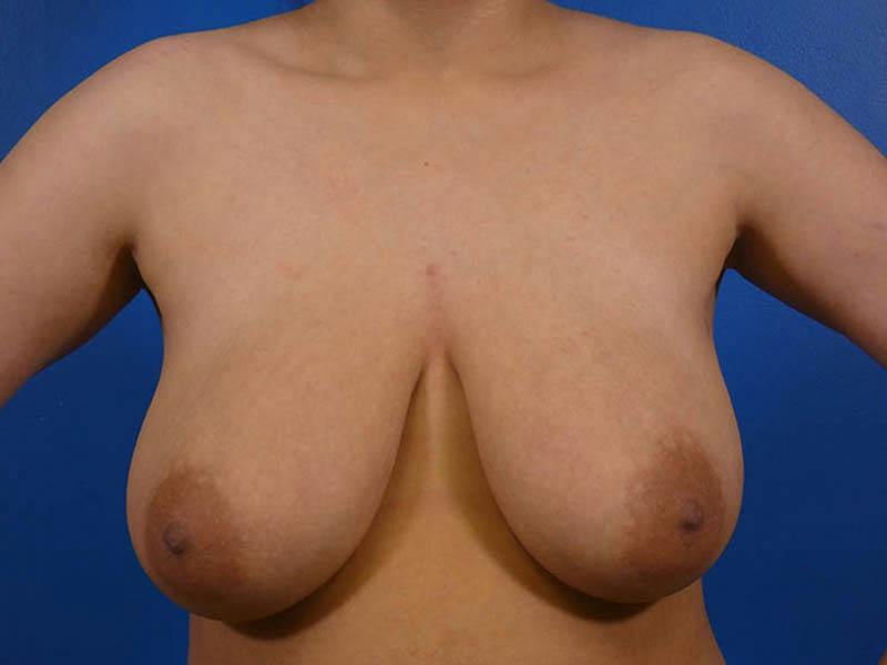 Breast Reduction Before & After Gallery - Patient 679513 - Image 1
