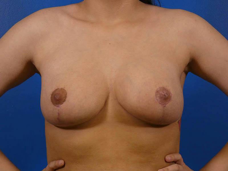 Breast Reduction Before & After Gallery - Patient 679513 - Image 2