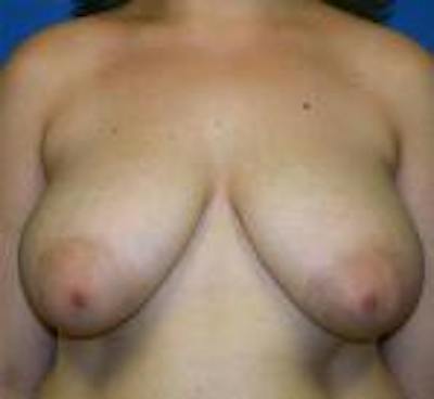 Breast Reduction Before & After Gallery - Patient 816160 - Image 1