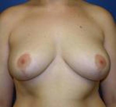 Breast Reduction Before & After Gallery - Patient 816160 - Image 2
