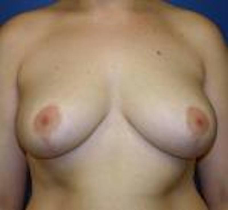 Breast Reduction Before & After Gallery - Patient 816160 - Image 2
