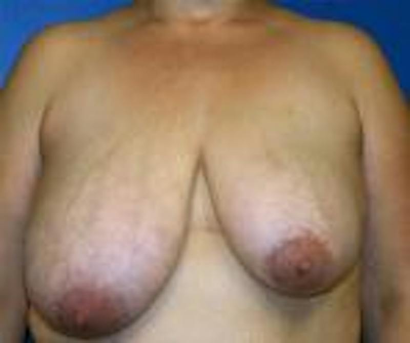Breast Reduction Before & After Gallery - Patient 929836 - Image 1