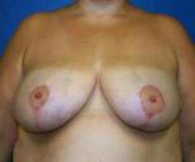 Breast Reduction Before & After Gallery - Patient 929836 - Image 2