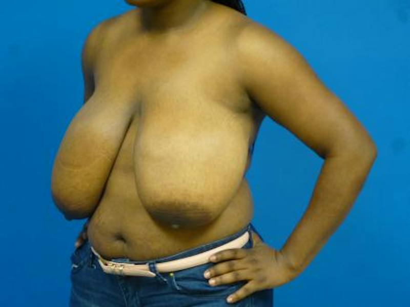 Breast Reduction Before & After Gallery - Patient 690353 - Image 1