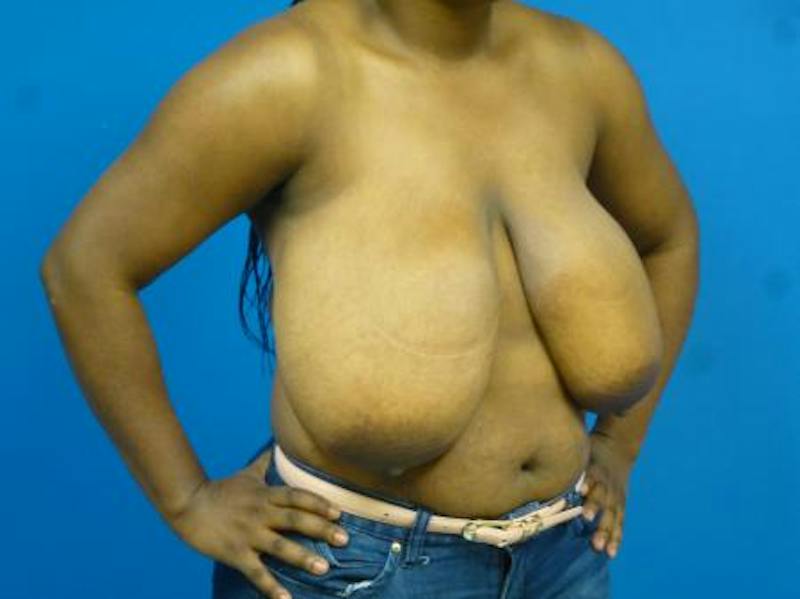 Breast Reduction Before & After Gallery - Patient 690353 - Image 3