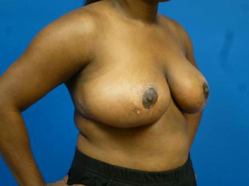 Breast Reduction Before & After Gallery - Patient 690353 - Image 4