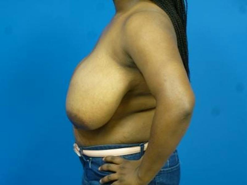 Breast Reduction Before & After Gallery - Patient 690353 - Image 5