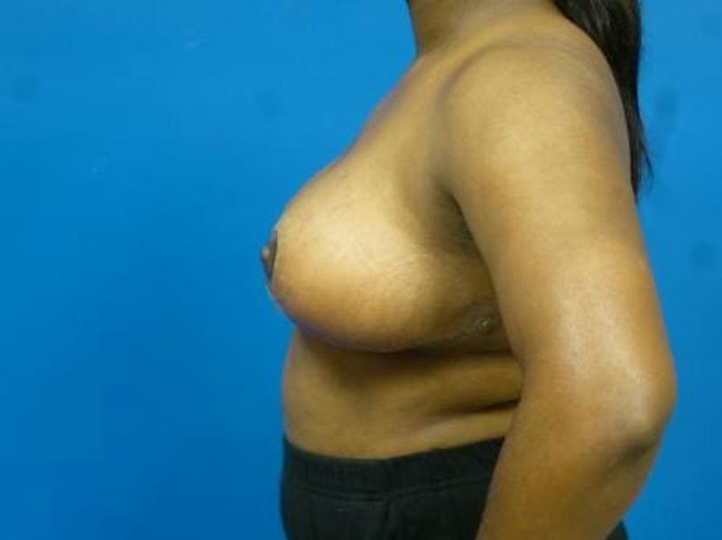 Breast Reduction Before & After Gallery - Patient 690353 - Image 6