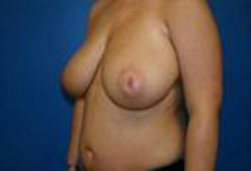 Breast Reduction Before & After Gallery - Patient 109499 - Image 1