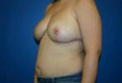 Breast Reduction Before & After Gallery - Patient 109499 - Image 2