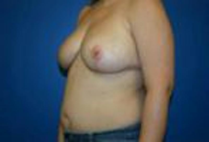Breast Reduction Before & After Gallery - Patient 109499 - Image 2