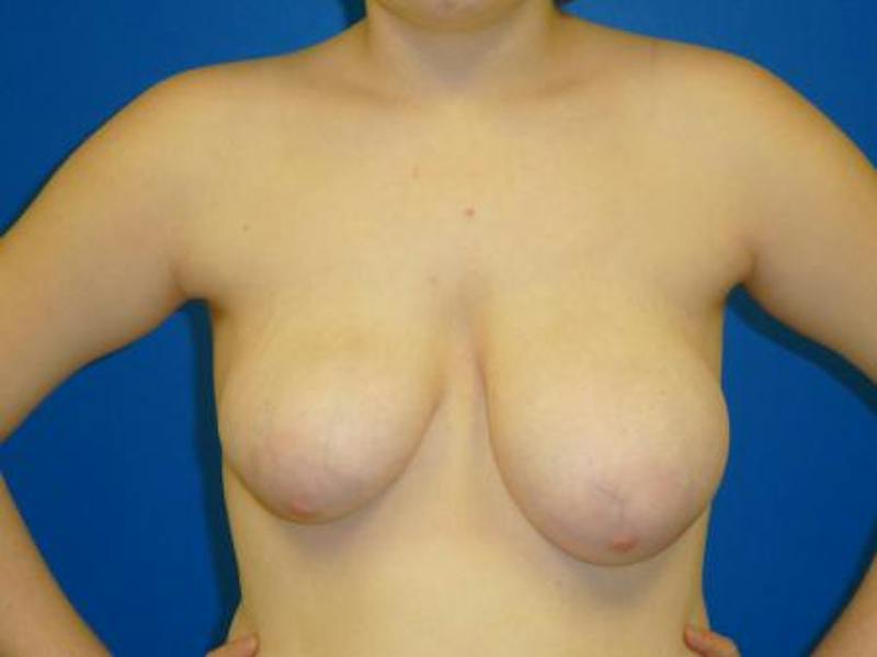 Breast Reduction Before & After Gallery - Patient 152616 - Image 1