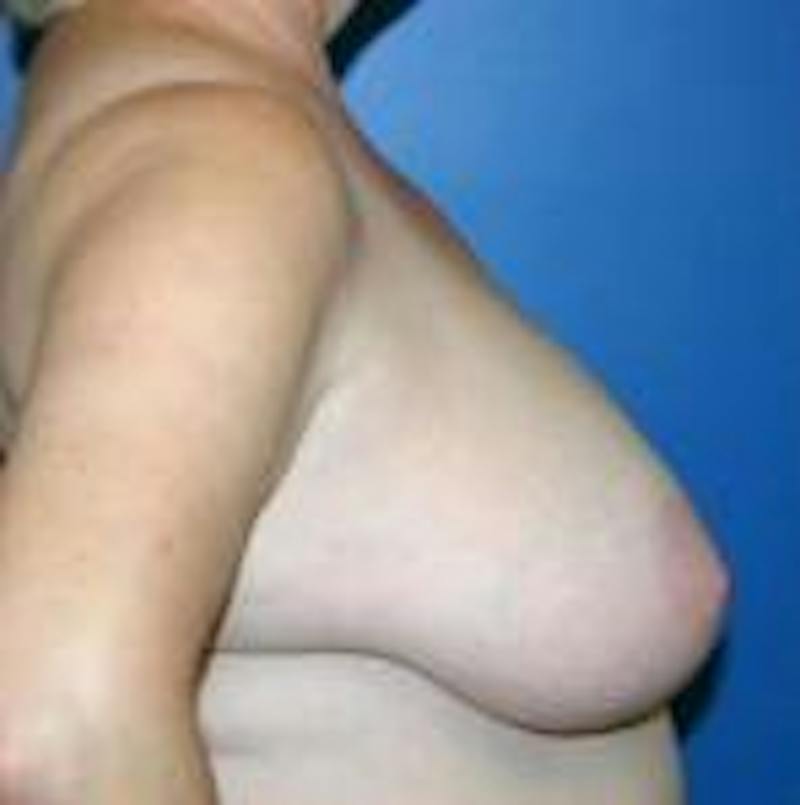 Breast Reduction Before & After Gallery - Patient 358591 - Image 3